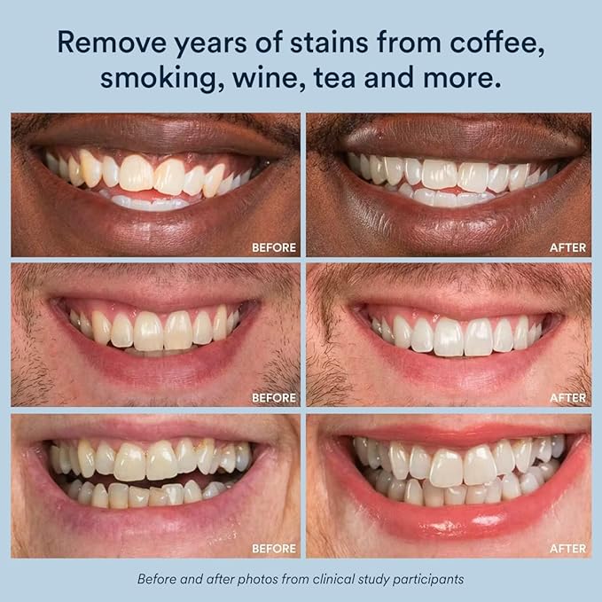 Auraglow Teeth Whitening Kit & 44% Teeth Whitening Gel Refill Pack